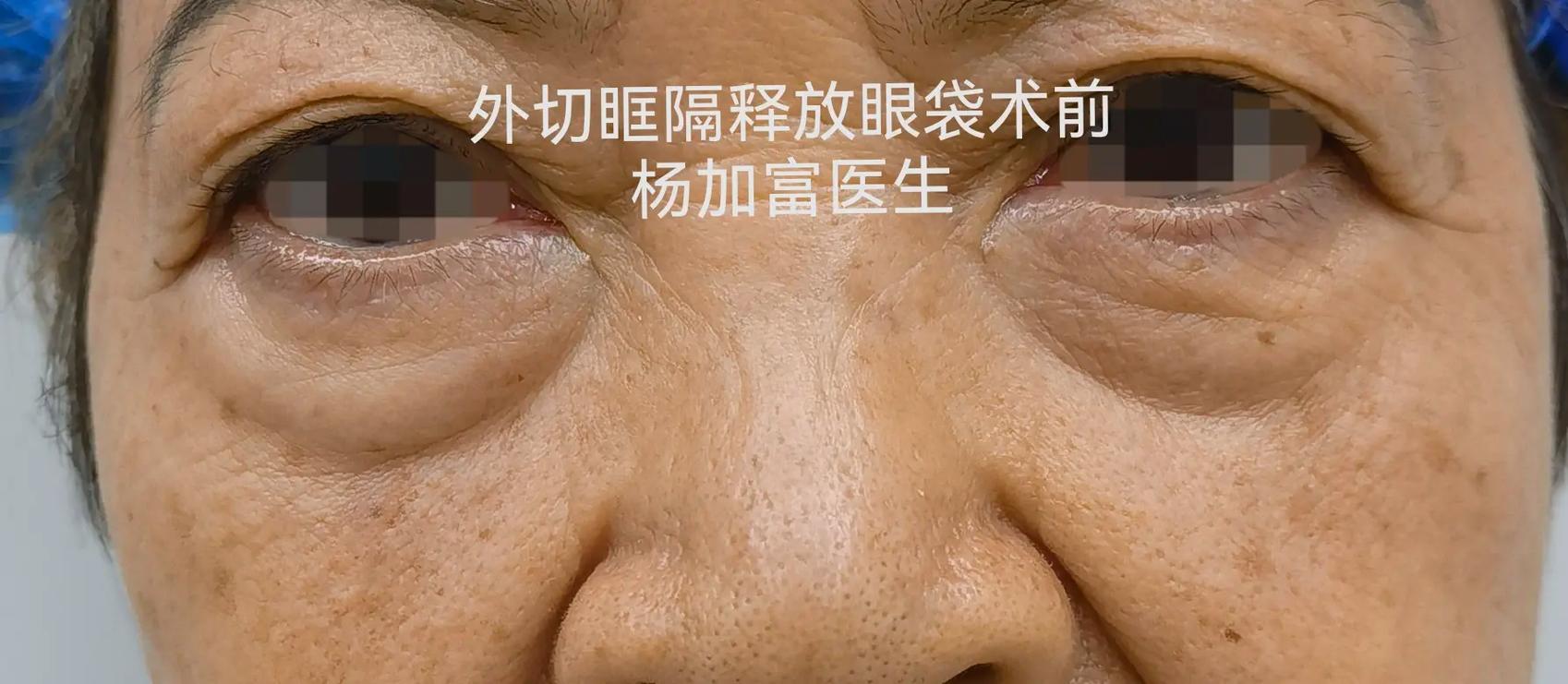 手术治疗眼袋_手术治疗眼袋的利与弊
