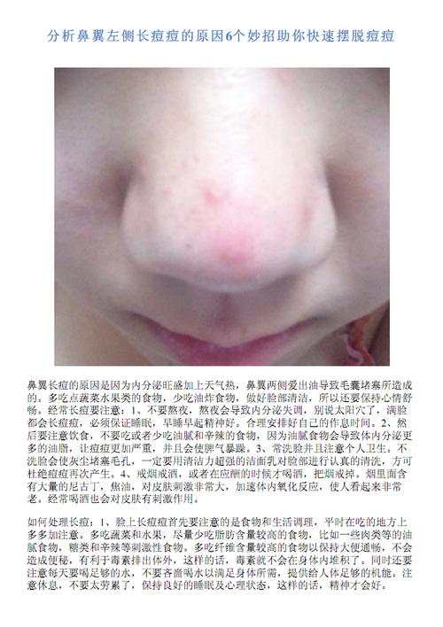 鼻翼上长痘_鼻翼上长痘怎么回事