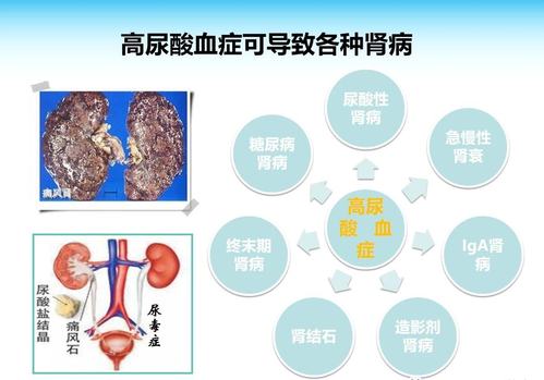 尿酸高是什么原因引起_尿酸高是什么原因引起的怎么治疗