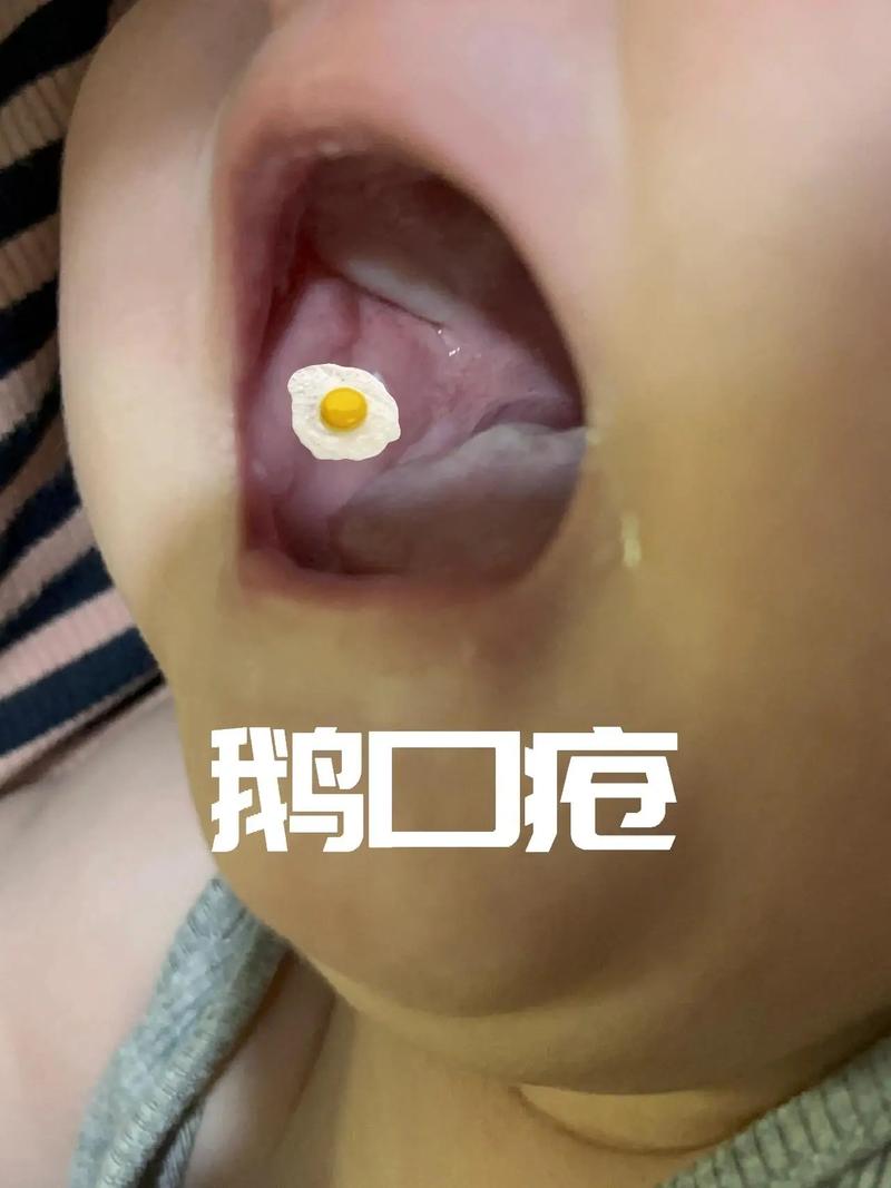 宝宝起鹅口疮怎么办_宝宝起鹅口疮怎么办啊